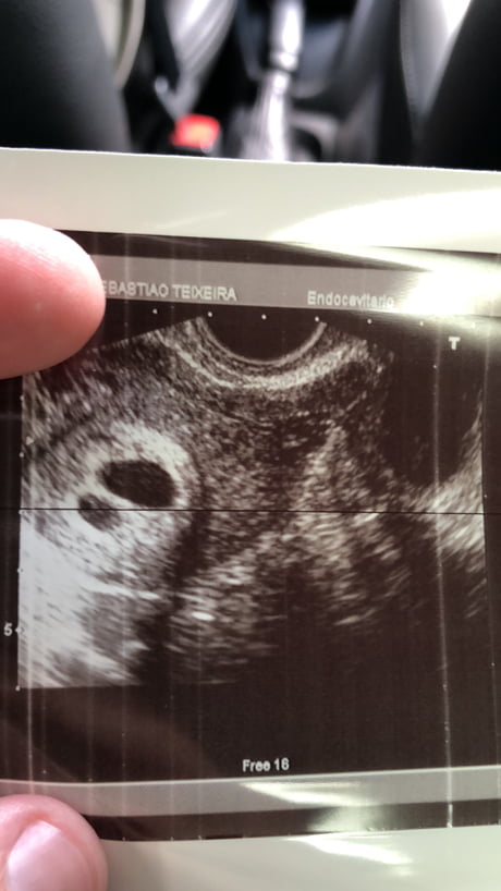 After ten years trying, we made it! My wife and I will have twin babies!