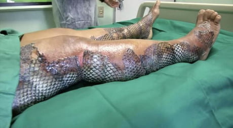 Certain fish skin can be grafted onto burns and diabetic wounds. The material recruits the body&#039;s own cells and is converted eventually into living tissue.